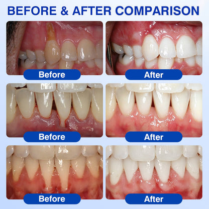 us👨‍⚕️✅🦷 Moragoon® Gum Protect Periodontal Repair Gel